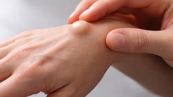 Primer plano de una mano con un quiste en la muñeca, siendo palpado suavemente por los dedos de otra mano