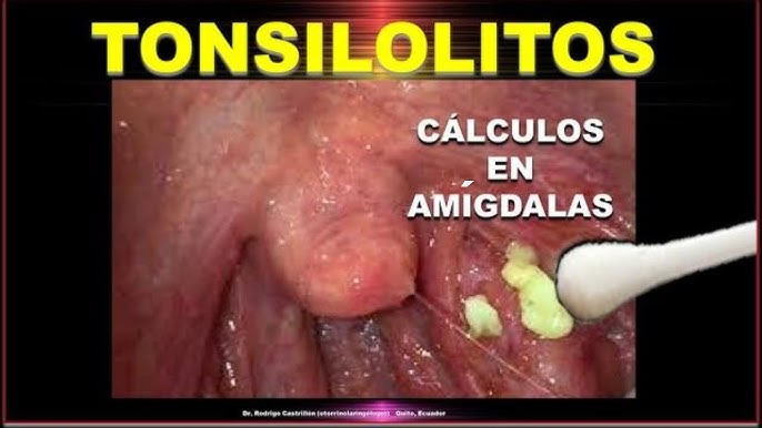 Tonsilolitos: qué son, causas y cómo eliminarlos de forma segura