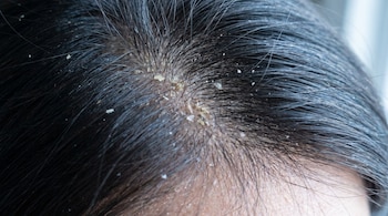 Primer plano de un cuero cabelludo con cabello oscuro y escamas blancas y amarillentas visibles en la raíz y la piel. La piel del cuero cabelludo se ve seca.