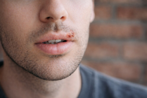 Cómo evitar la aparición del herpes labial