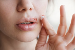 Cómo evitar la aparición del herpes labial