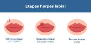 Cómo evitar la aparición del herpes labial