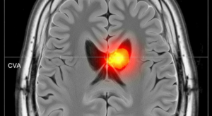 5 señales que podrían indicar un accidente cerebrovascular