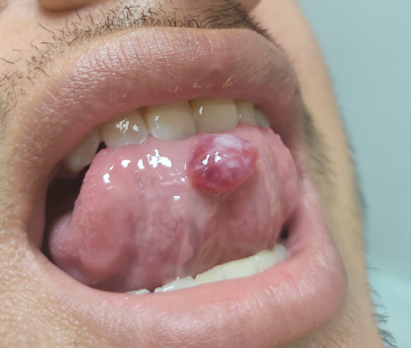 Tengo un bulto en la lengua | Docencia Rafalafena