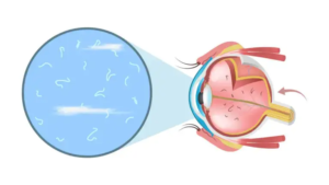 ¿Qué son las miodesopsias? - Explicación y manejo