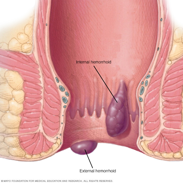 Hemorroides // Middlesex Health