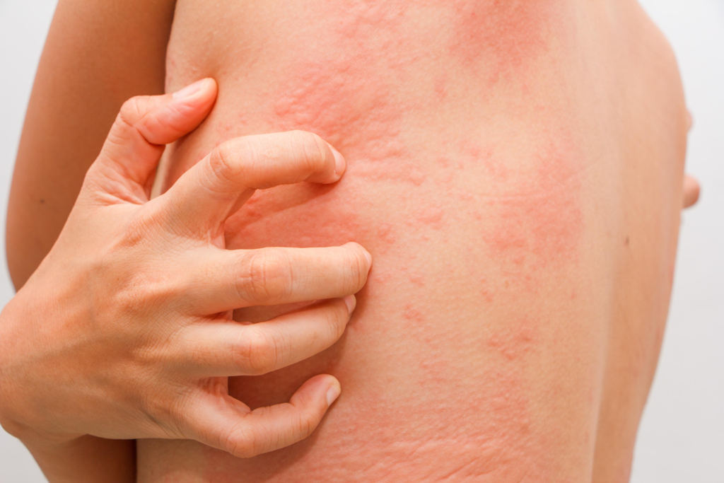 ¿Alergia o hematoma? Por qué una imagen no revela la verdad completa - DK EaCash
