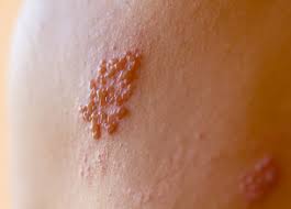 Lo que pocos conocen sobre el herpes zóster, una enfermedad silenciosa que aparece sin aviso
