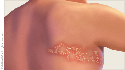 Lo que pocos conocen sobre el herpes zóster, una enfermedad silenciosa que aparece sin aviso