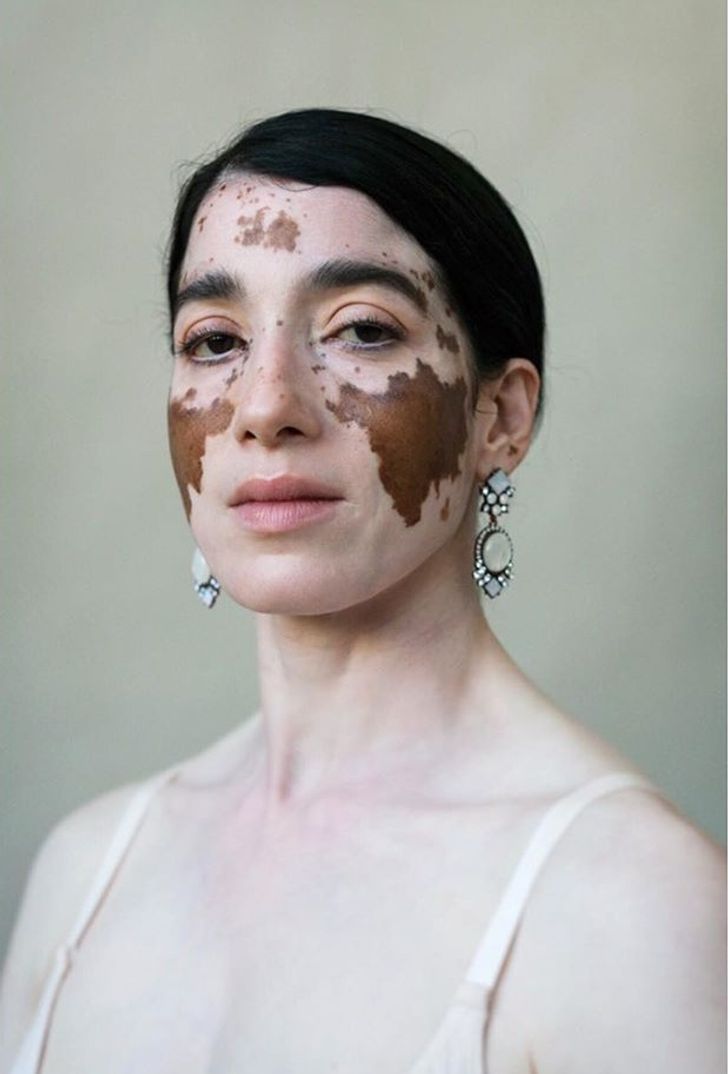 Una fotógrafa muestra con orgullo la belleza de las mujeres con vitíligo