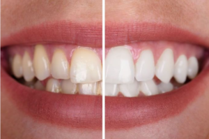 Cómo mantener dientes sin sarro, blancos y saludables de forma natural
