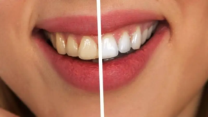 Cómo mantener dientes sin sarro, blancos y saludables de forma natural