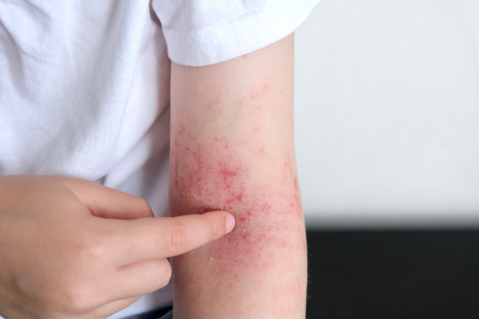 Sarpullido En Niños Sin Fiebre: Causas Y Tratamientos | Bupa Latinoamérica