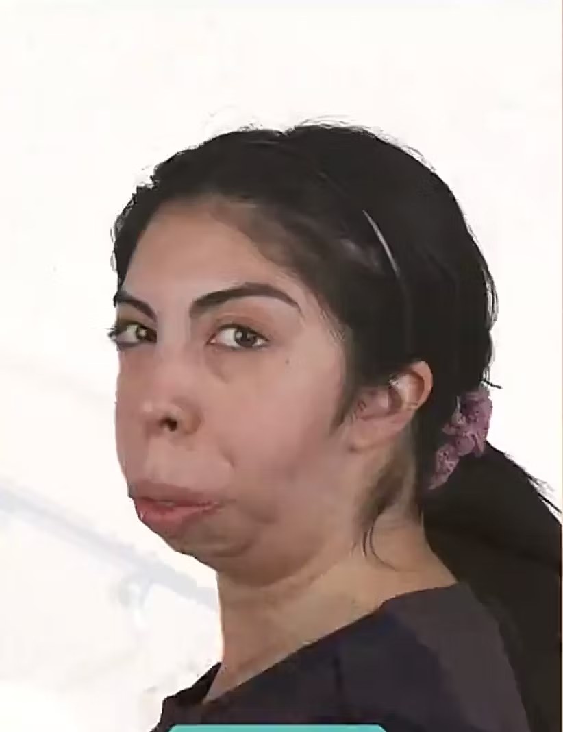 Joven chilena comparte impactante transformación tras cirugía facial financiada por sus seguidores en redes sociales
