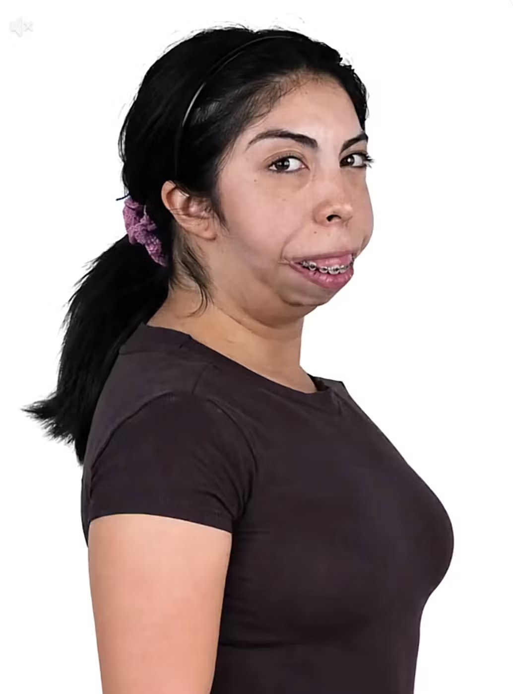Joven chilena comparte impactante transformación tras cirugía facial financiada por sus seguidores en redes sociales
