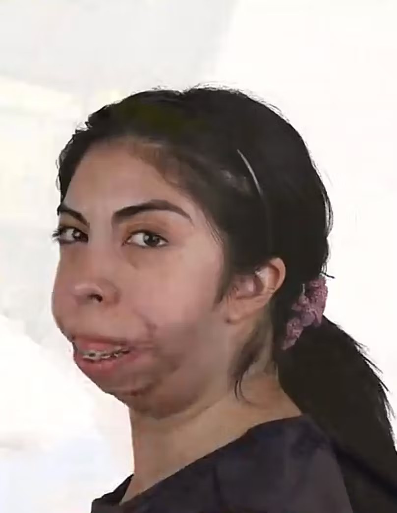 Joven chilena comparte impactante transformación tras cirugía facial financiada por sus seguidores en redes sociales