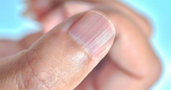Significado de las Rayas en las Uñas y Cuándo Acudir al Dermatólogo - DK EaCash