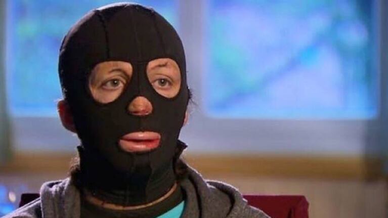 Turia vivió con una máscara para ocultar las marcas que la tragedia dejó en todo su rostro. (Foto: News.com.au)