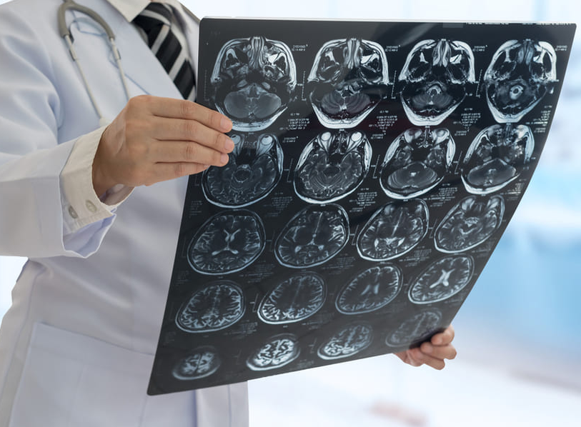 Tu cuerpo puede alertarte sobre un posible derrame cerebral
