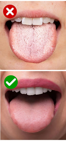 Lengua blanca: cuándo es normal y cuándo indica un problema de salud