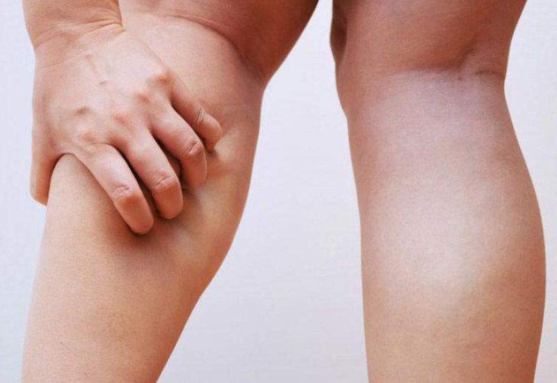 Primer síntoma del colesterol alto que suele pasar desapercibido